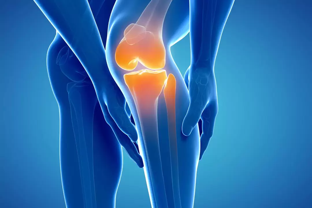 Osteoarthritis of the knee (knee osteoarthritis, degenerative joint deformity)