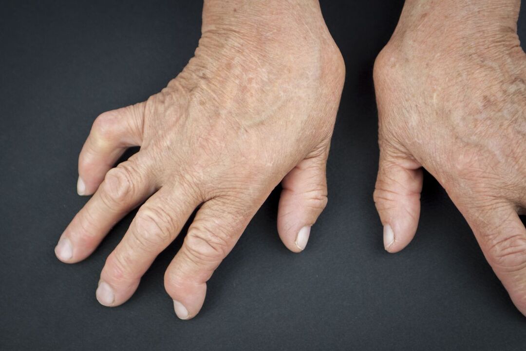 gout in the hands