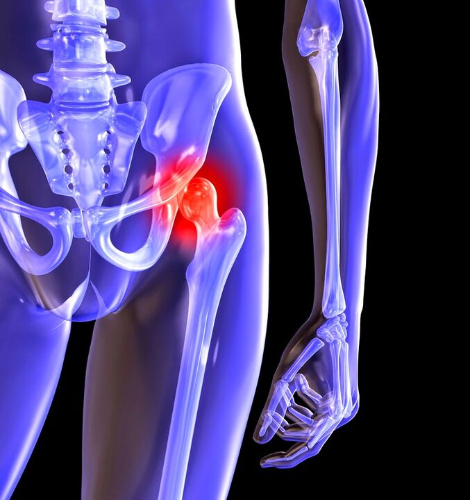 Deforming joints of the hip joint