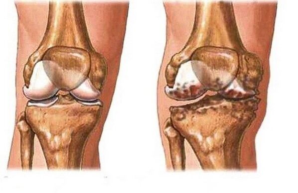 Healthy and painful joints