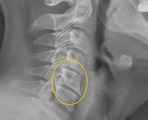 Fiber of the cervical spine on a x -ray