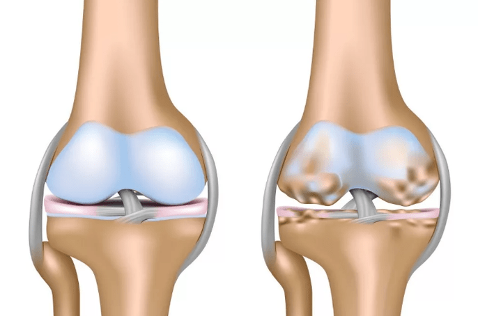 Deformation of the knee joint
