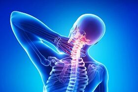 neck pain due to osteoarthritis