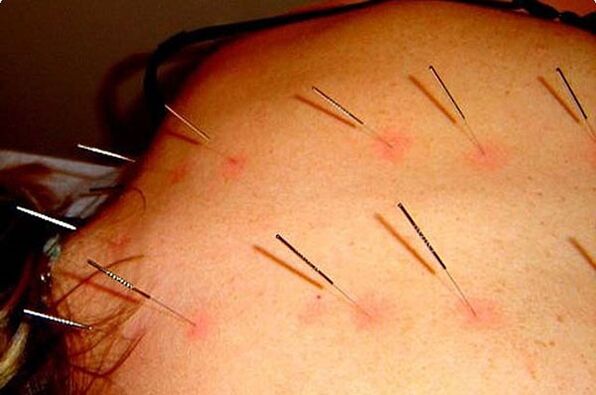 Acupuncture – a treatment method for cervical spondylosis