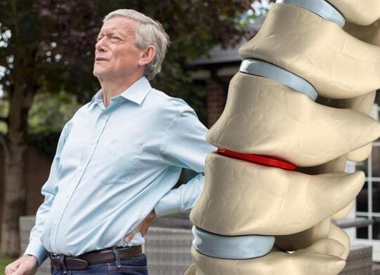 Osteoarthritis affects the discs and causes back pain