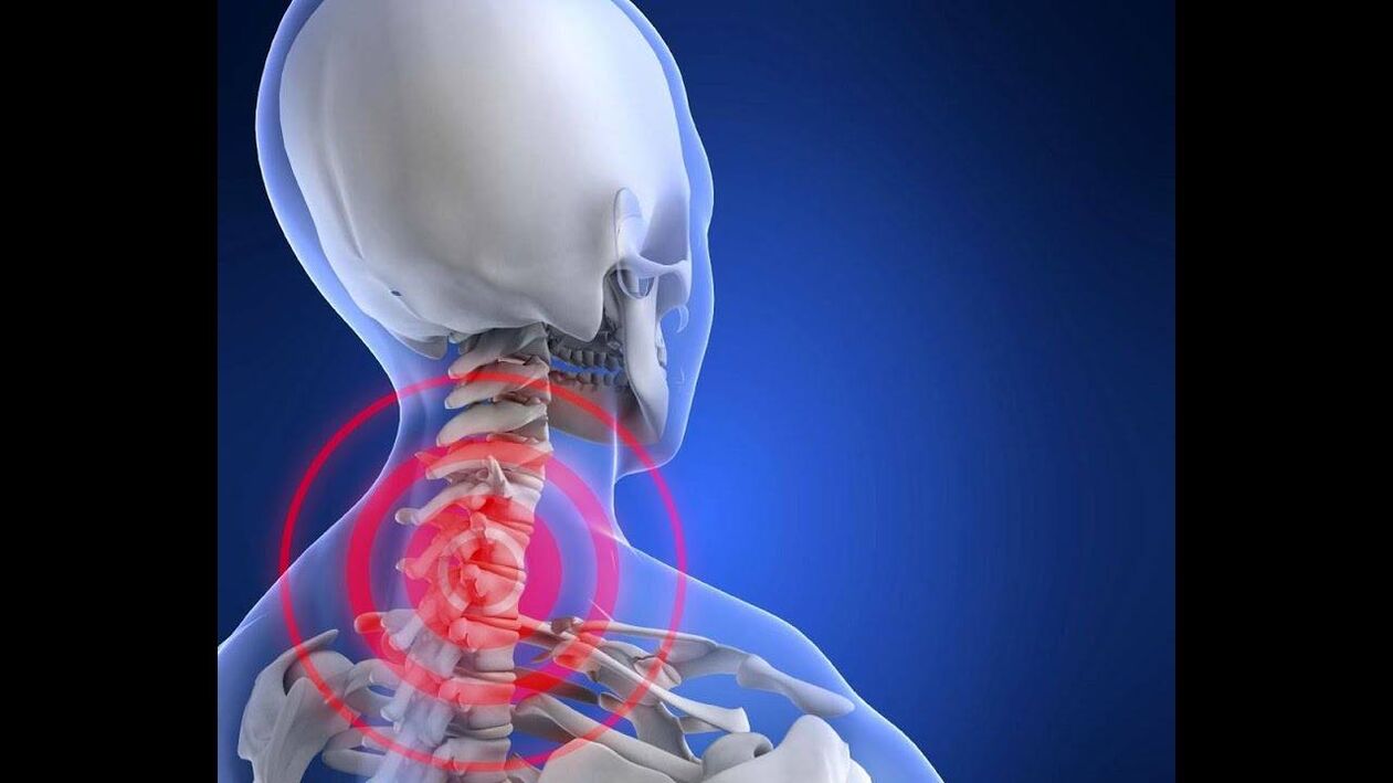 Cervical spine degeneration